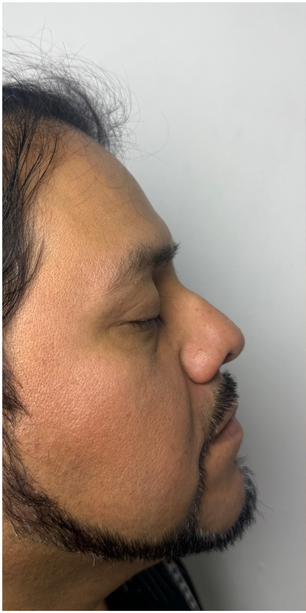 Antes